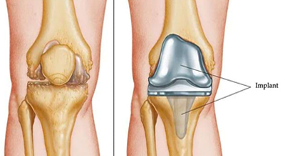 Arthroplasty